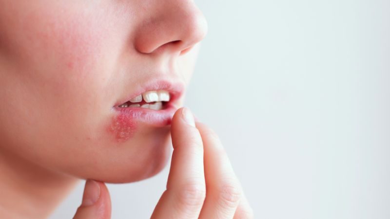 Mittel gegen Herpes - Was kann ich gegen Herpes tun?